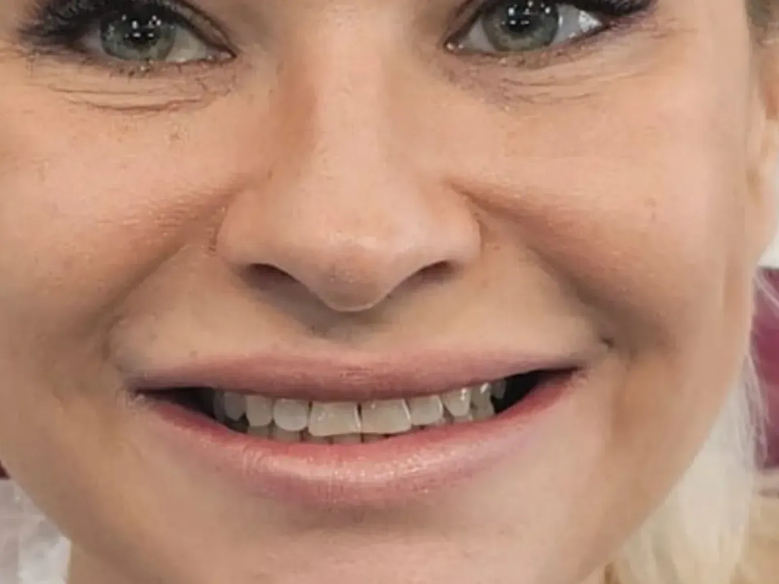 Przed implanty zębowe — przypadek z naszej kliniki